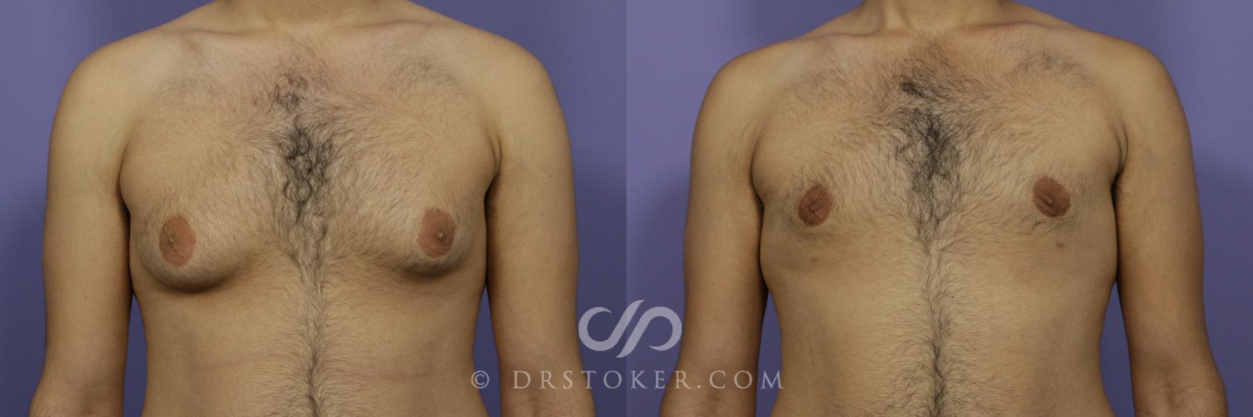 Before & After Breast Reduction for Men (Gynecomastia) Case 780 View #1 View in Los Angeles, CA