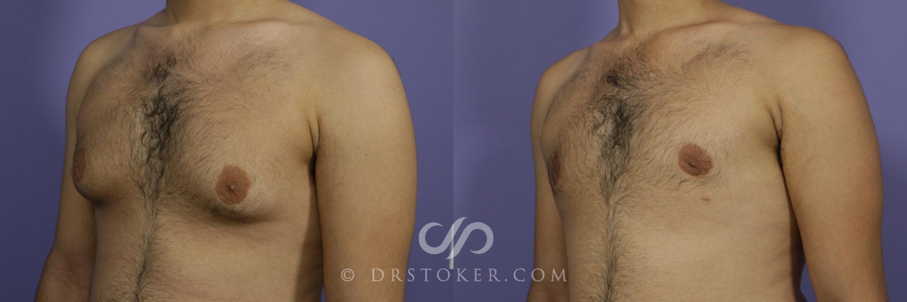 Before & After Breast Reduction for Men (Gynecomastia) Case 780 View #4 View in Los Angeles, CA