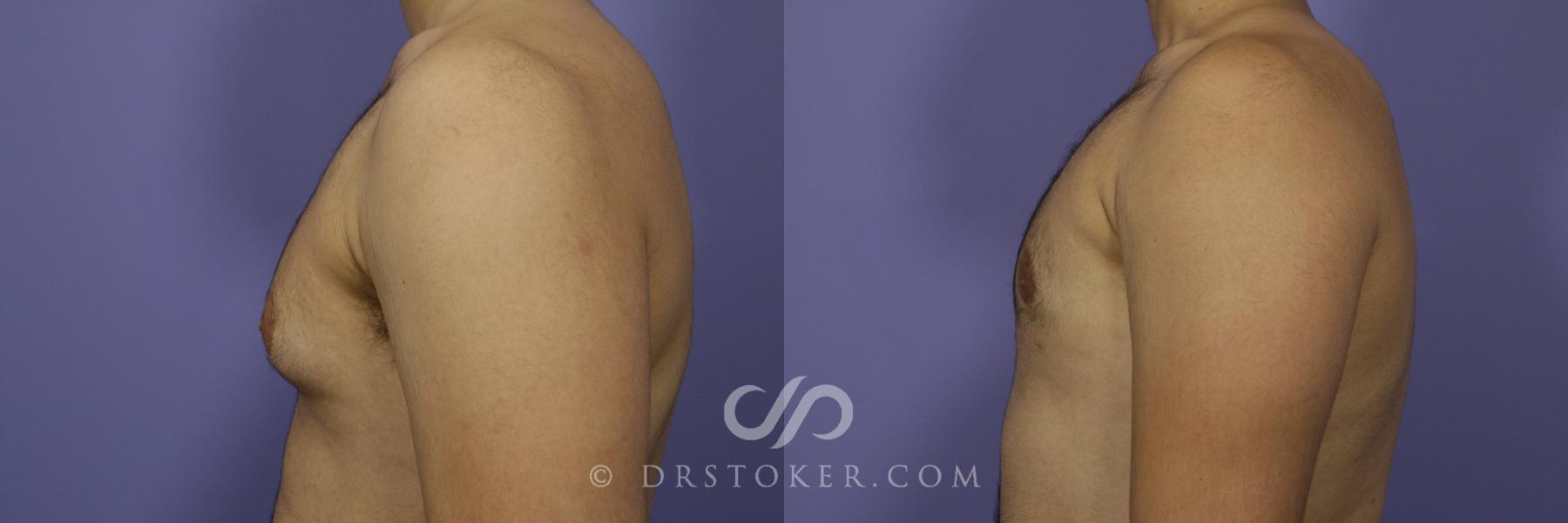 Before & After Breast Reduction for Men (Gynecomastia) Case 780 View #5 View in Los Angeles, CA