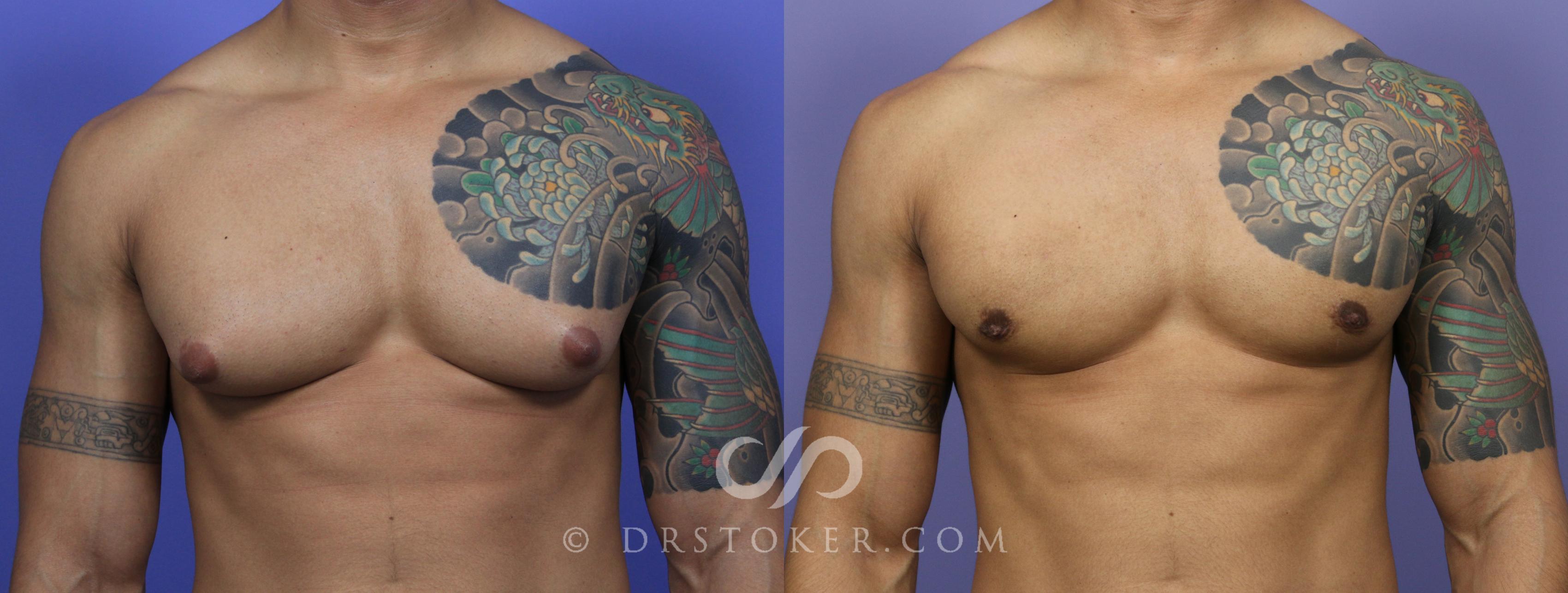 Before & After Breast Reduction for Men (Gynecomastia) Case 782 View #1 View in Los Angeles, CA