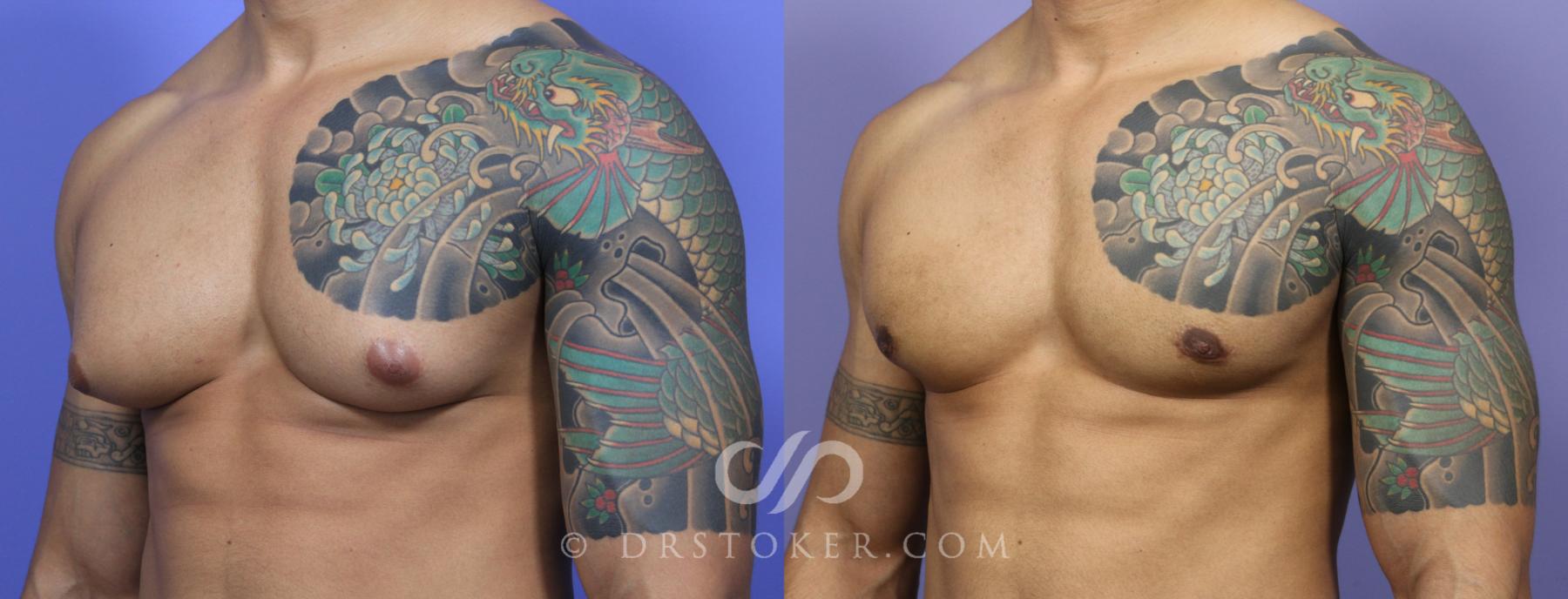Before & After Breast Reduction for Men (Gynecomastia) Case 782 View #3 View in Los Angeles, CA