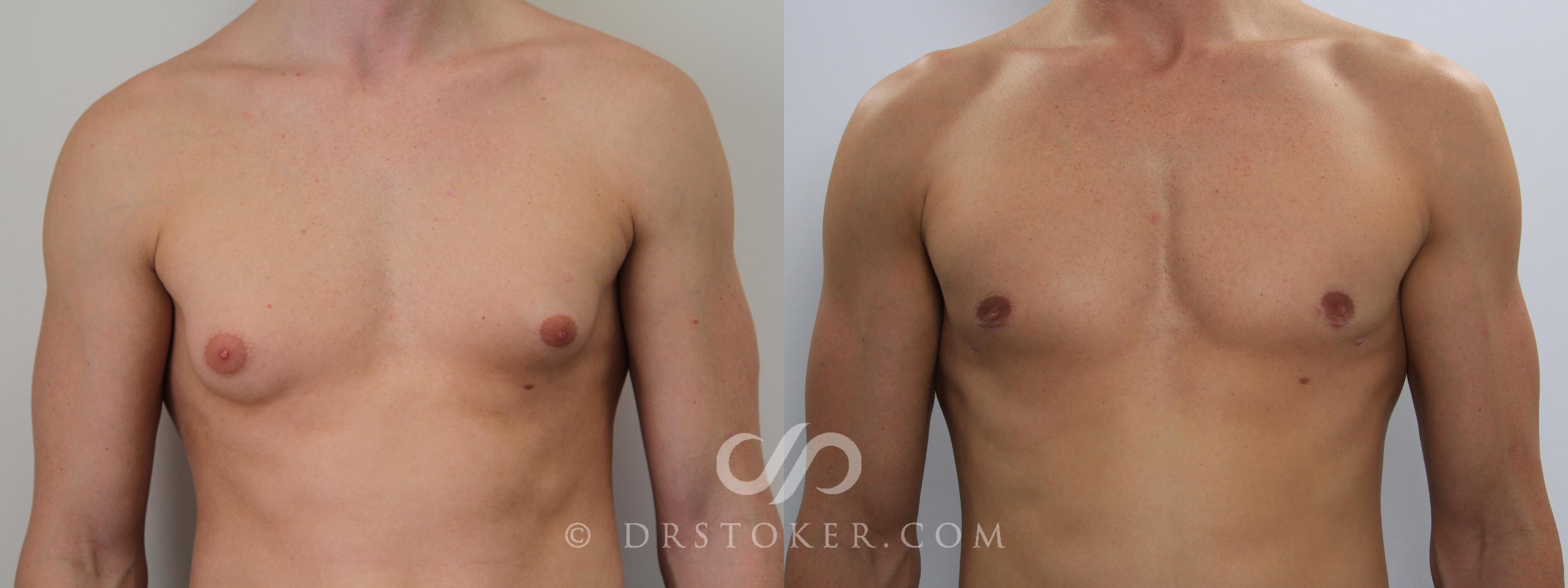 Before & After Breast Reduction for Men (Gynecomastia) Case 783 View #1 View in Marina del Rey, CA