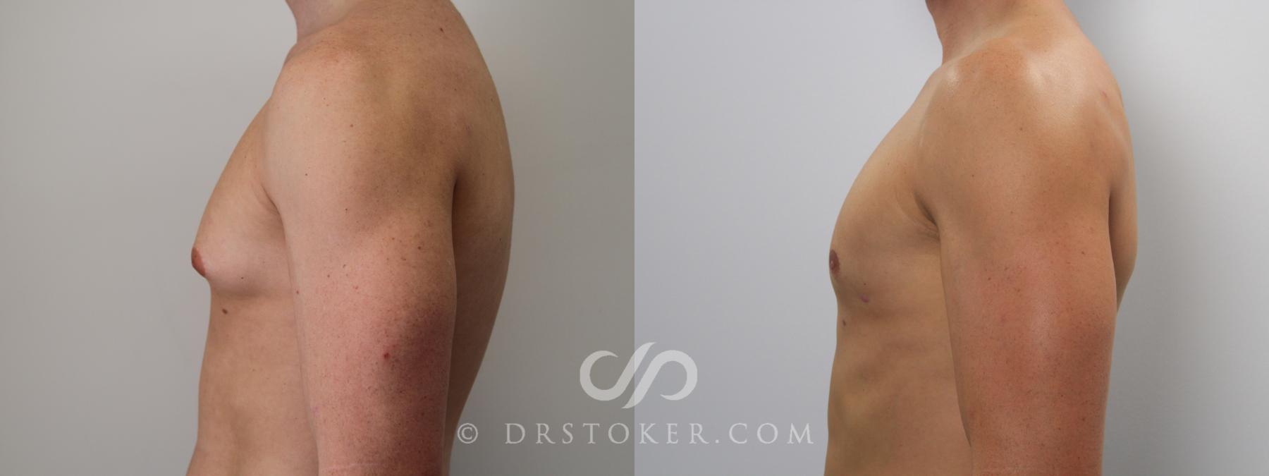 Before & After Breast Reduction for Men (Gynecomastia) Case 783 View #2 View in Los Angeles, CA