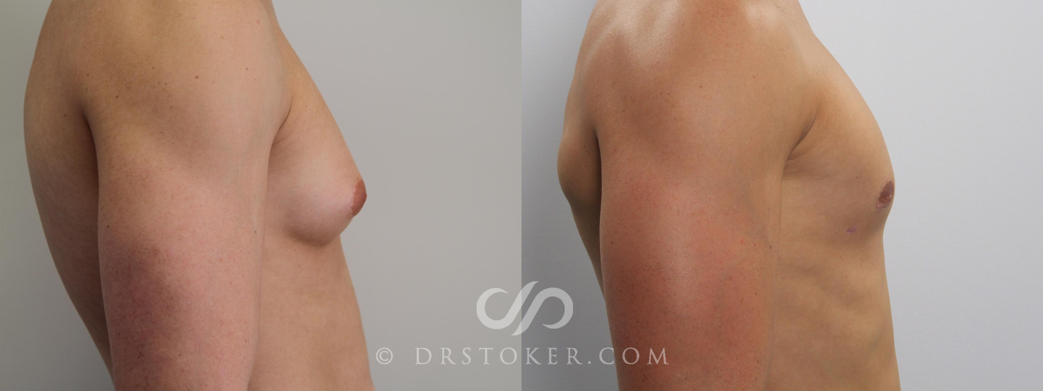 Before & After Breast Reduction (for Men) Case 785 View #1 View in Los Angeles, CA