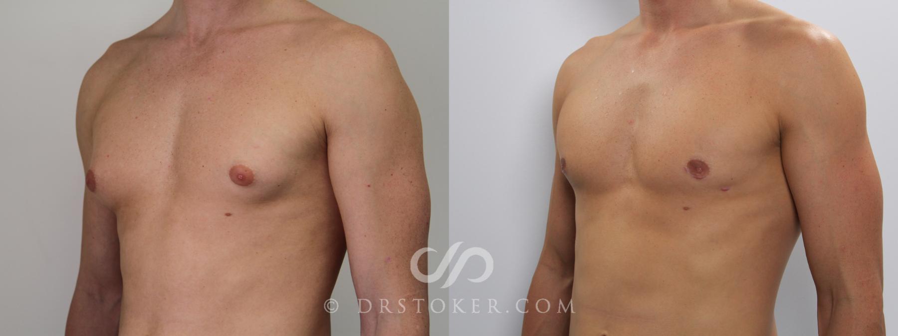 Before & After Breast Reduction for Men (Gynecomastia) Case 785 View #2 View in Los Angeles, CA
