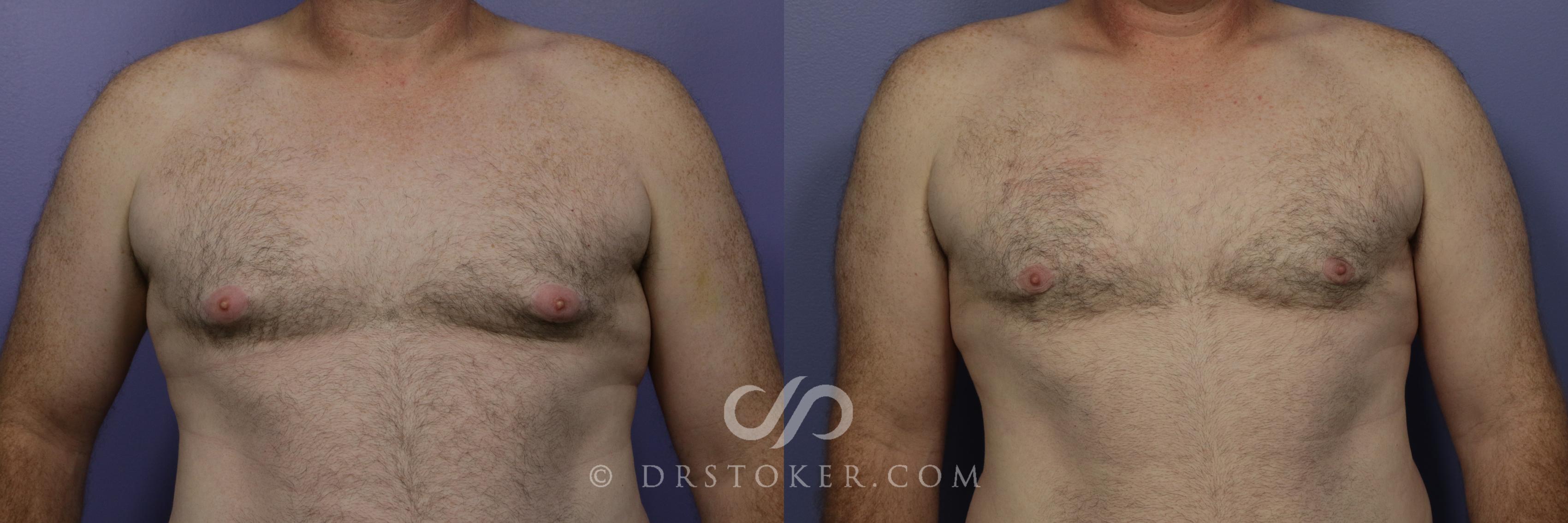 Before & After Breast Reduction for Men (Gynecomastia) Case 786 View #1 View in Marina del Rey, CA
