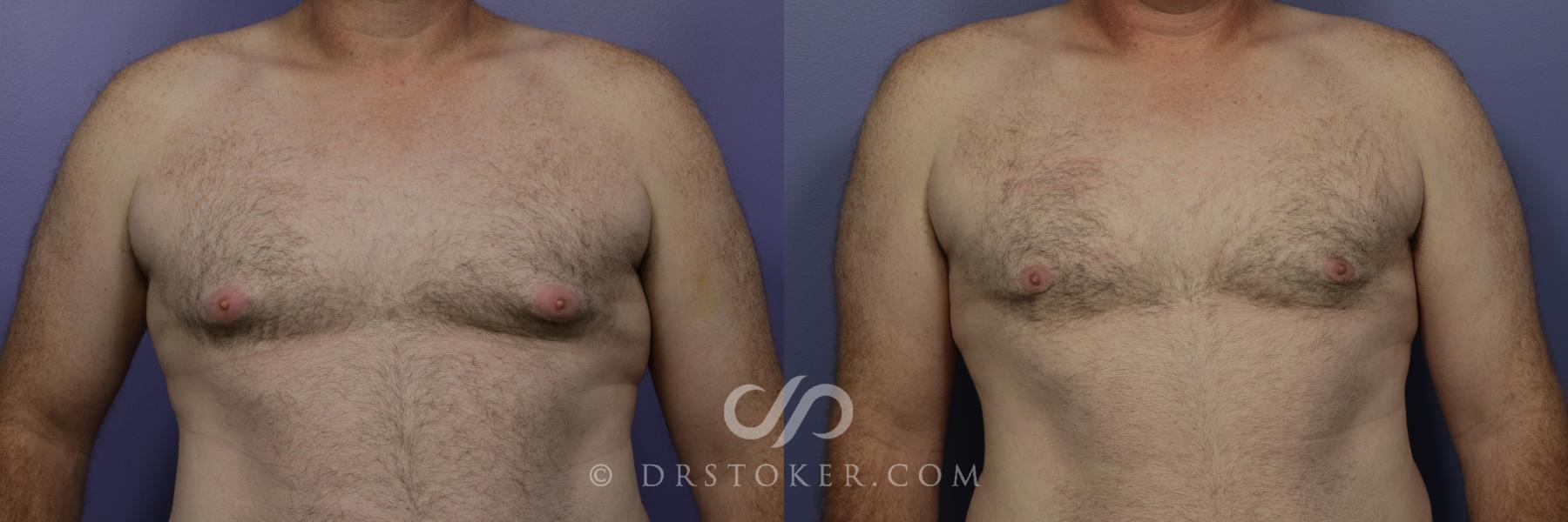 Before & After Breast Reduction for Men (Gynecomastia) Case 786 View #1 View in Los Angeles, CA