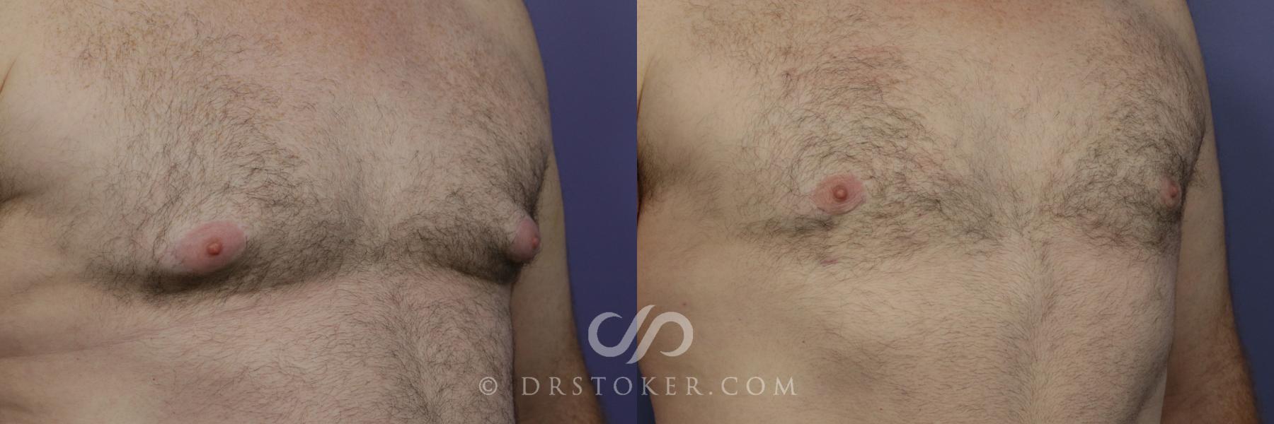 Before & After Breast Reduction for Men (Gynecomastia) Case 786 View #2 View in Los Angeles, CA
