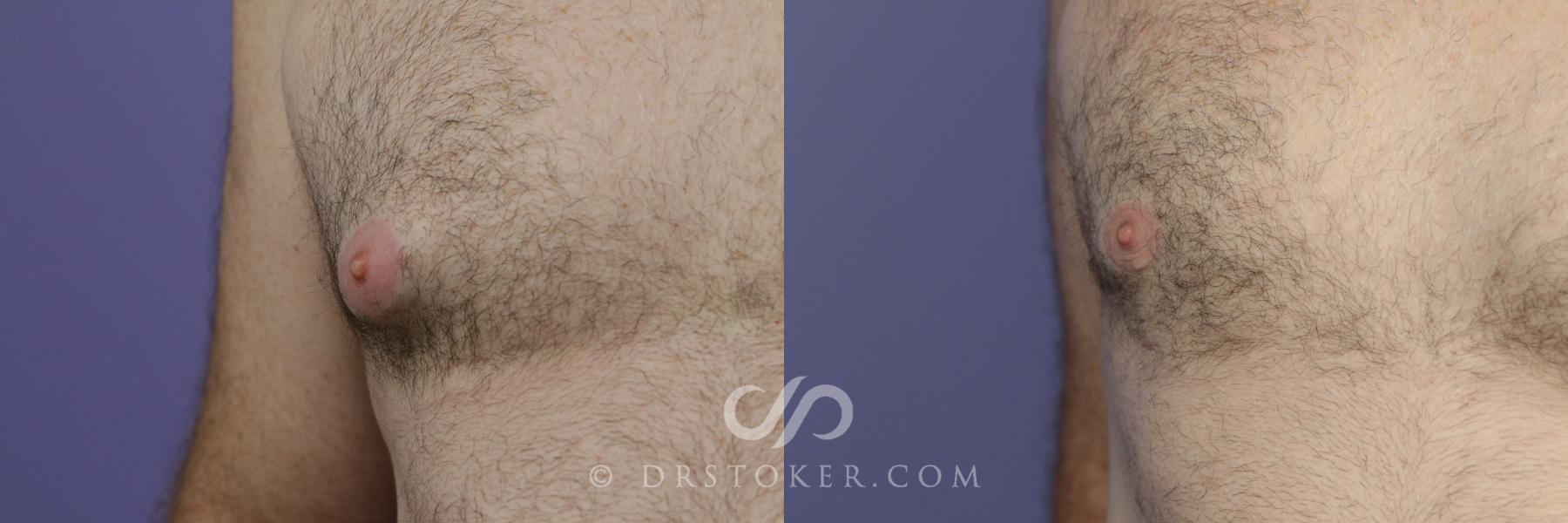 Before & After Breast Reduction for Men (Gynecomastia) Case 786 View #3 View in Los Angeles, CA
