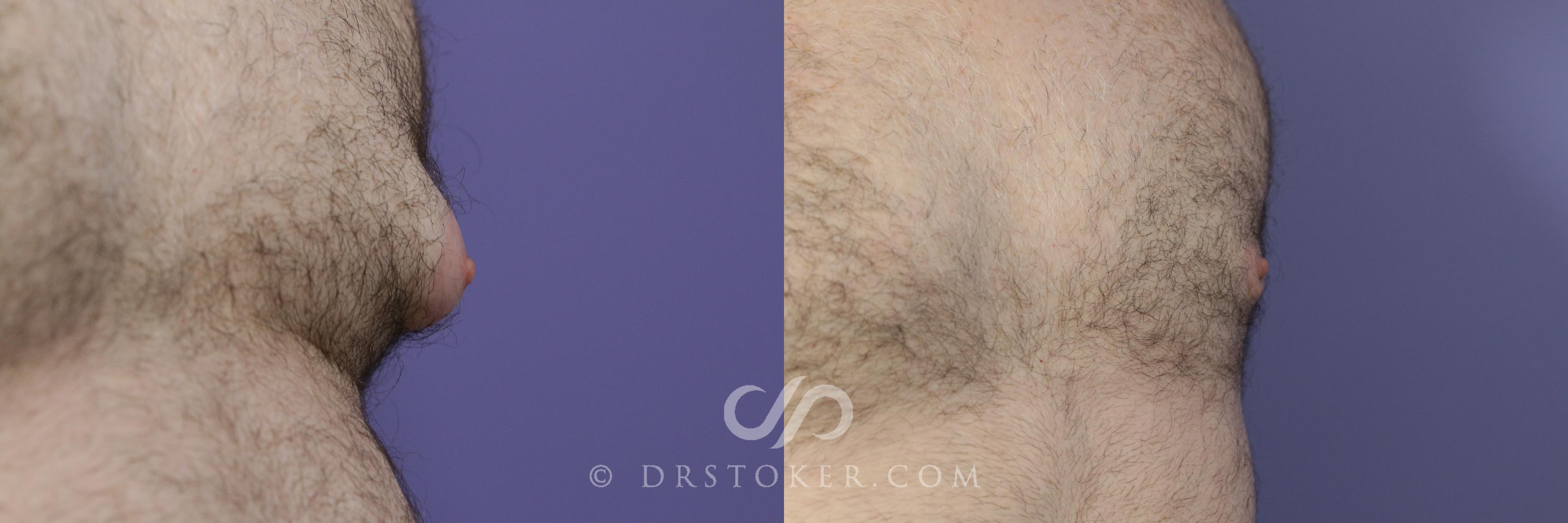 Before & After Breast Reduction for Men (Gynecomastia) Case 787 View #1 View in Marina del Rey, CA