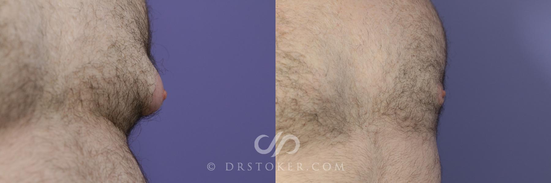 Before & After Breast Reduction for Men (Gynecomastia) Case 787 View #1 View in Los Angeles, CA