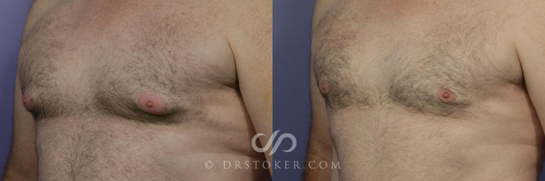 Before & After Breast Reduction for Men (Gynecomastia) Case 787 View #2 View in Los Angeles, CA