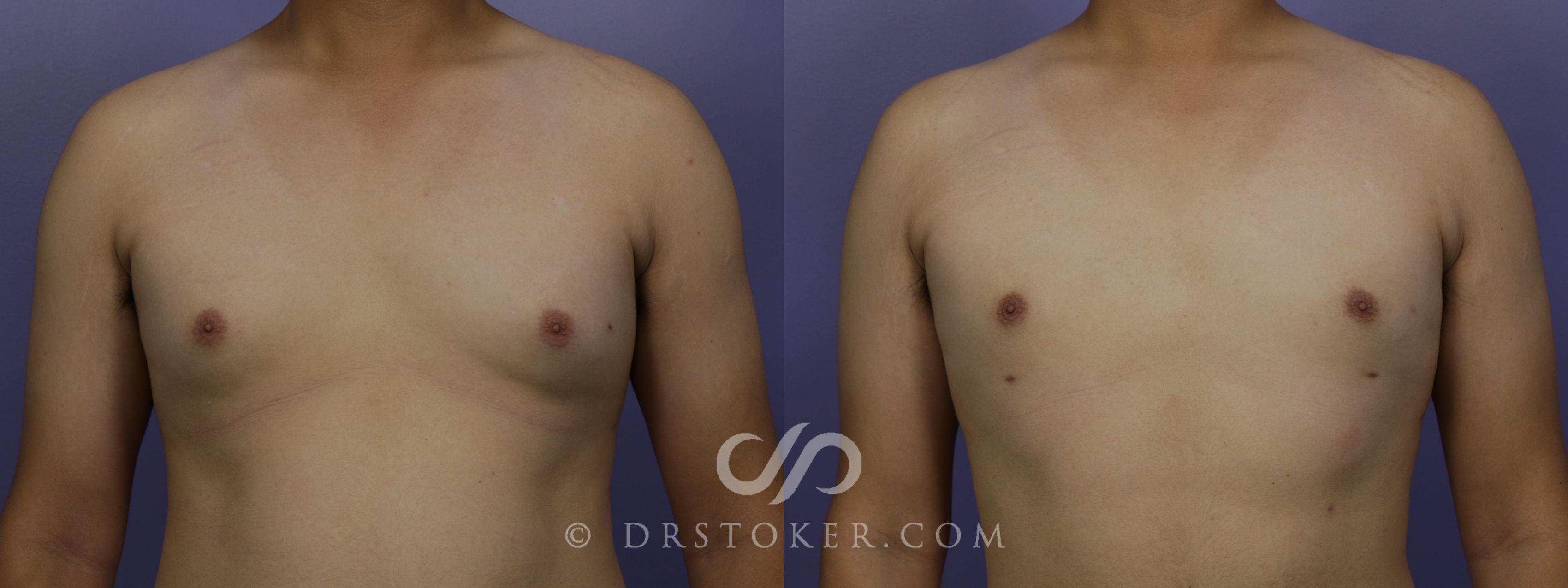 Before & After Breast Reduction for Men (Gynecomastia) Case 1279 View #1 View in Los Angeles, CA