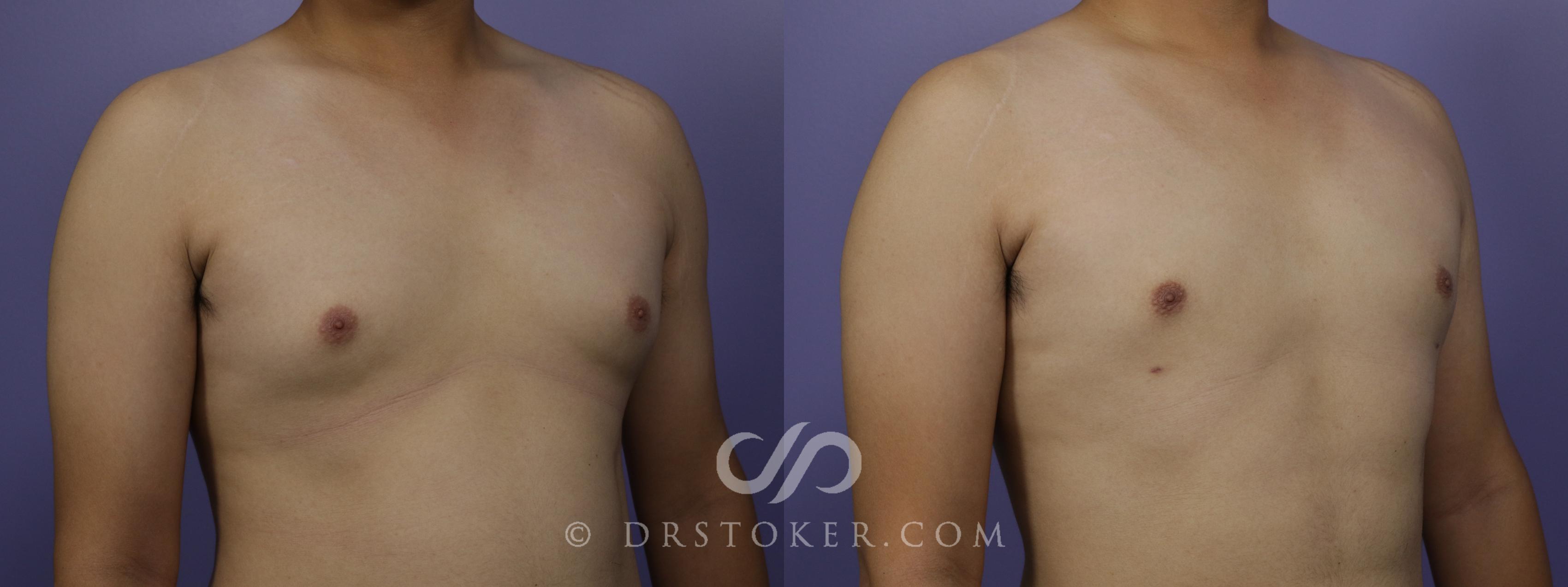 Before & After Breast Reduction for Men (Gynecomastia) Case 1279 View #2 View in Los Angeles, CA