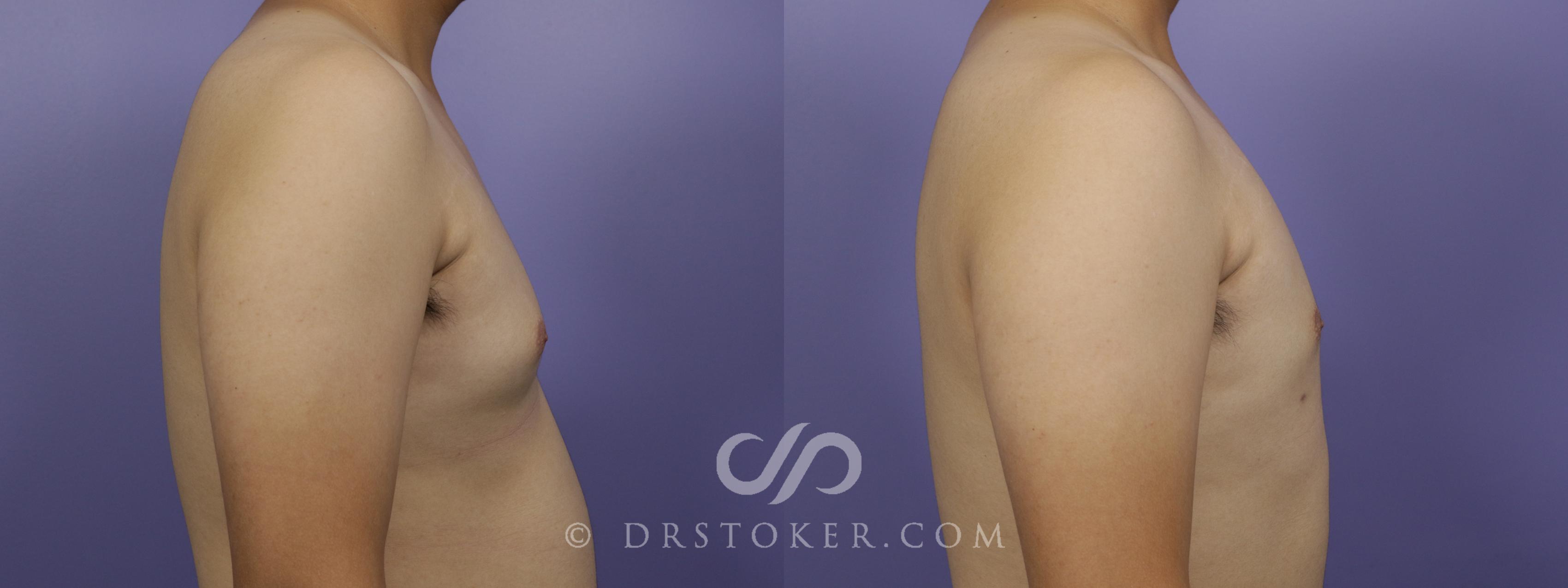 Before & After Breast Reduction for Men (Gynecomastia) Case 1279 View #3 View in Los Angeles, CA