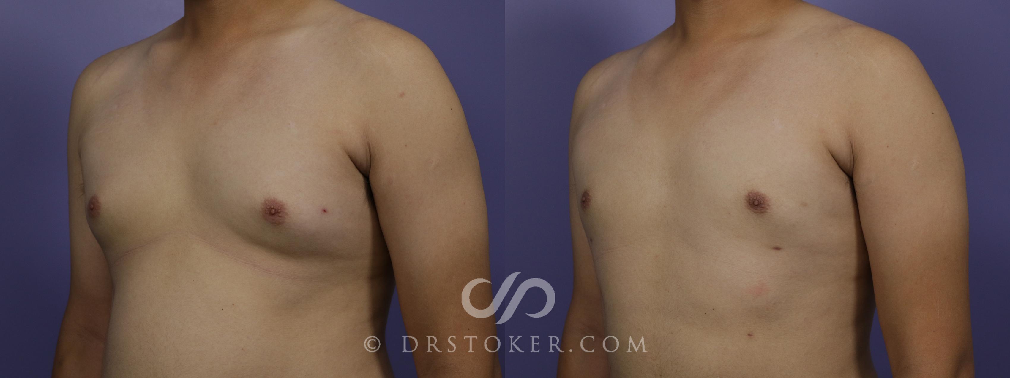 Before & After Breast Reduction for Men (Gynecomastia) Case 1280 View #1 View in Los Angeles, CA