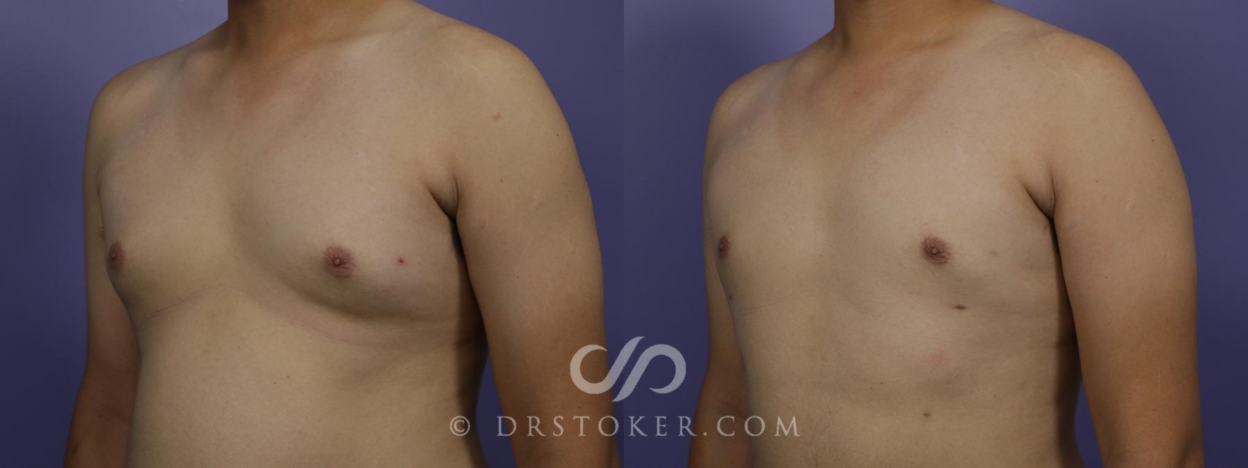 Before & After Breast Reduction for Men (Gynecomastia) Case 1280 View #1 View in Los Angeles, CA