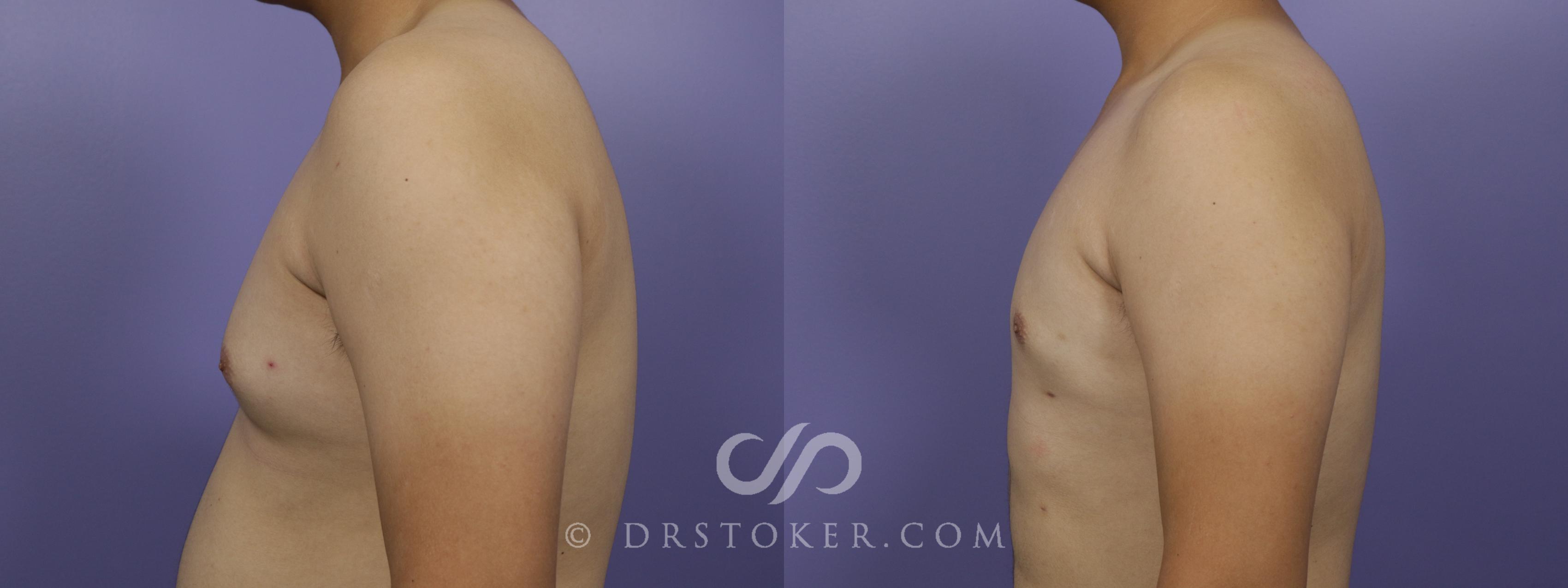 Before & After Breast Reduction for Men (Gynecomastia) Case 1280 View #2 View in Los Angeles, CA