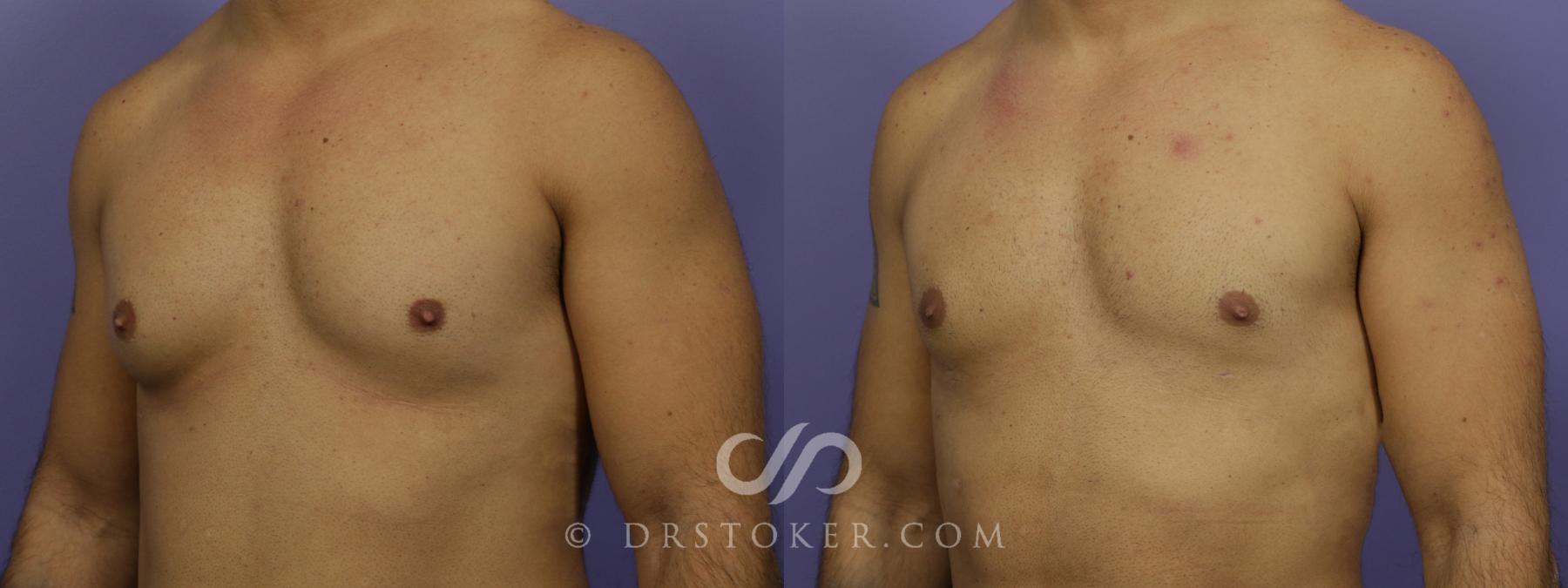 Before & After Breast Reduction for Men (Gynecomastia) Case 1282 View #1 View in Los Angeles, CA