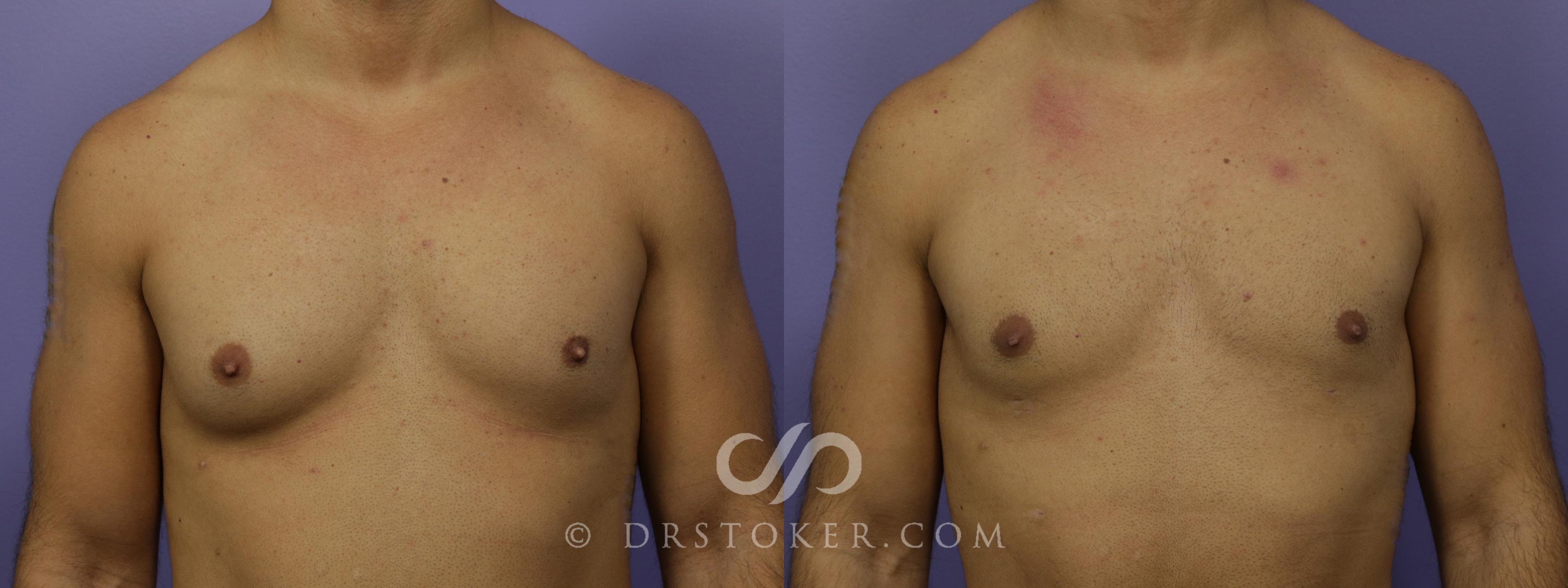 Before & After Breast Reduction for Men (Gynecomastia) Case 1283 View #1 View in Los Angeles, CA