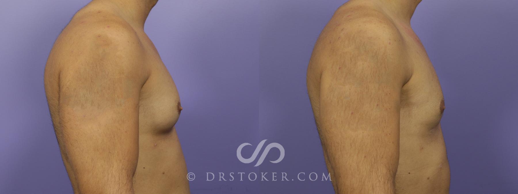 Before & After Breast Reduction for Men (Gynecomastia) Case 1286 View #1 View in Los Angeles, CA