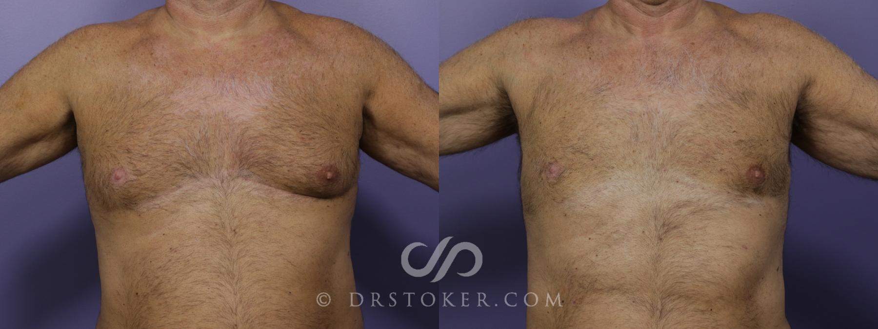 Before & After Breast Reduction for Men (Gynecomastia) Case 1287 View #1 View in Los Angeles, CA