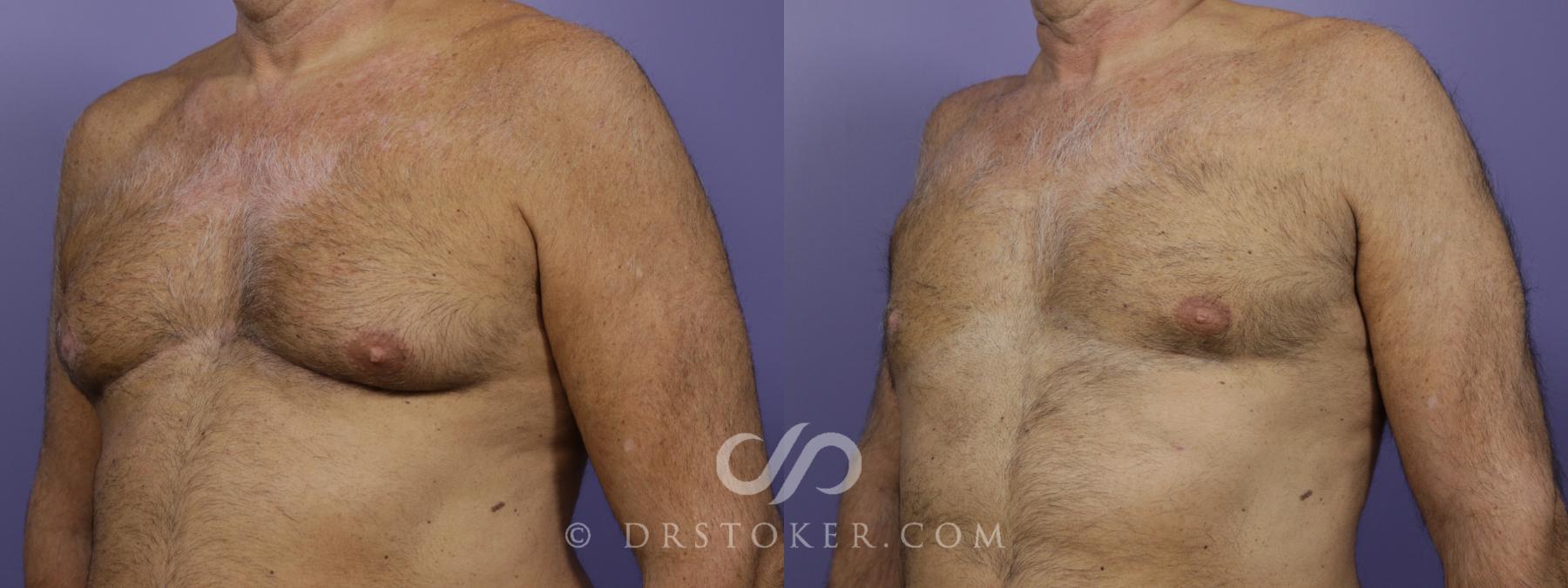 Before & After Breast Reduction for Men (Gynecomastia) Case 1287 View #2 View in Los Angeles, CA