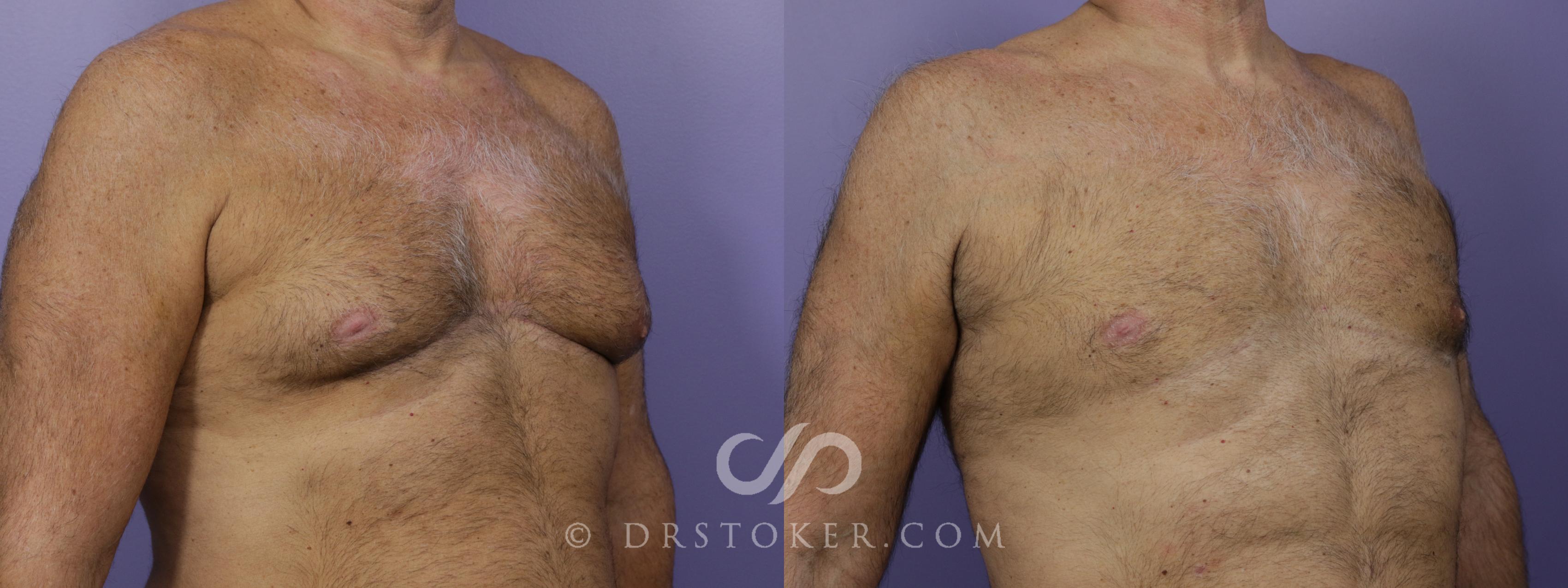 Before & After Breast Reduction (for Men) Case 1288 View #1 View in Marina del Rey, CA