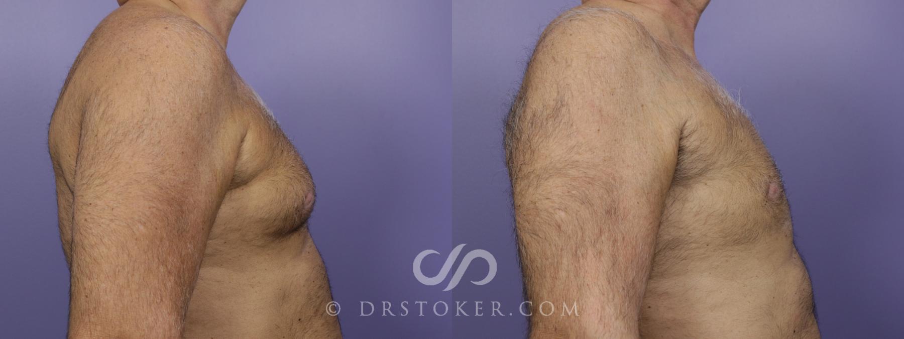 Before & After Breast Reduction for Men (Gynecomastia) Case 1288 View #2 View in Los Angeles, CA