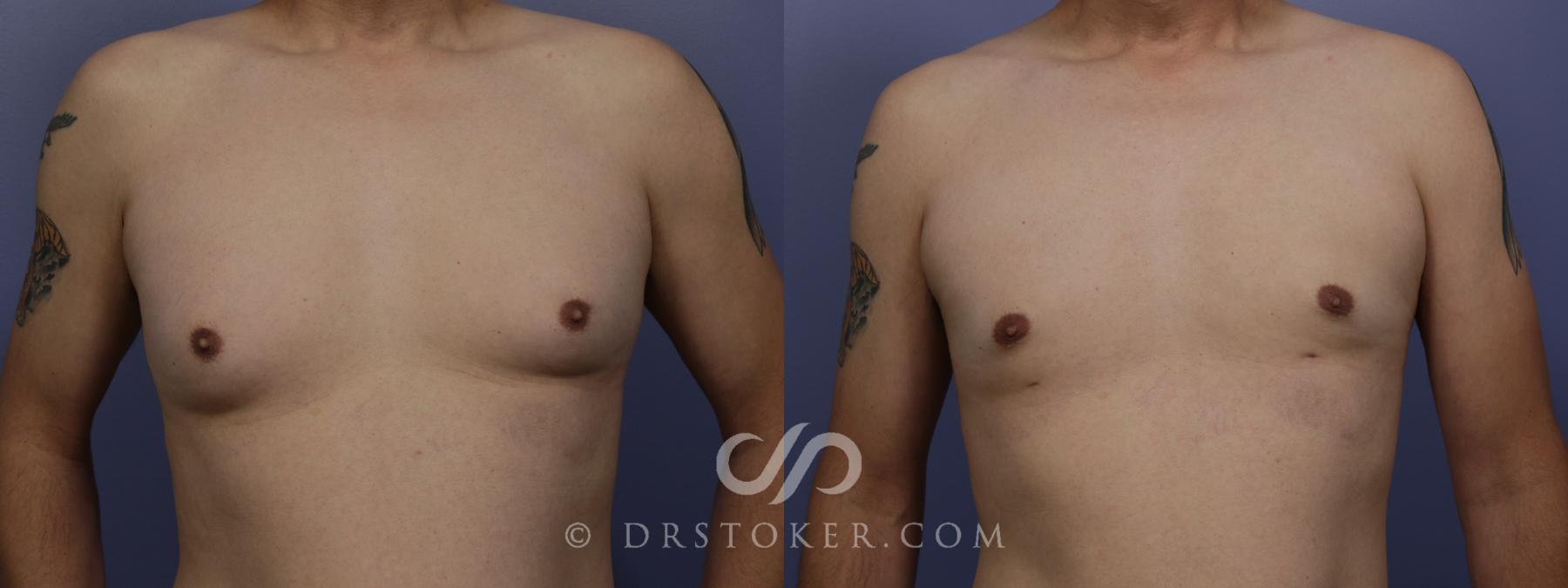 Before & After Breast Reduction for Men (Gynecomastia) Case 1412 View #1 View in Los Angeles, CA