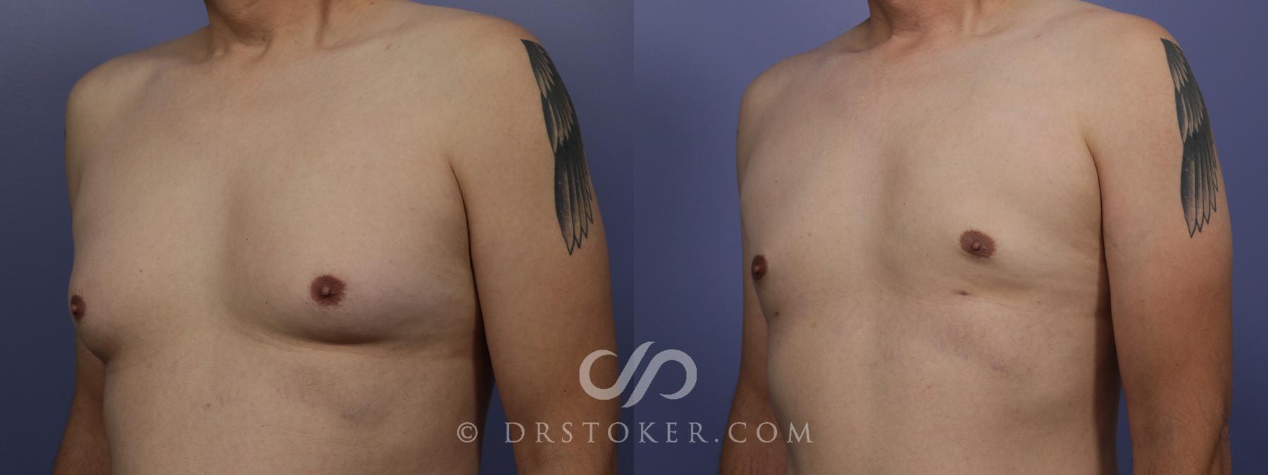 Before & After Breast Reduction for Men (Gynecomastia) Case 1412 View #2 View in Los Angeles, CA