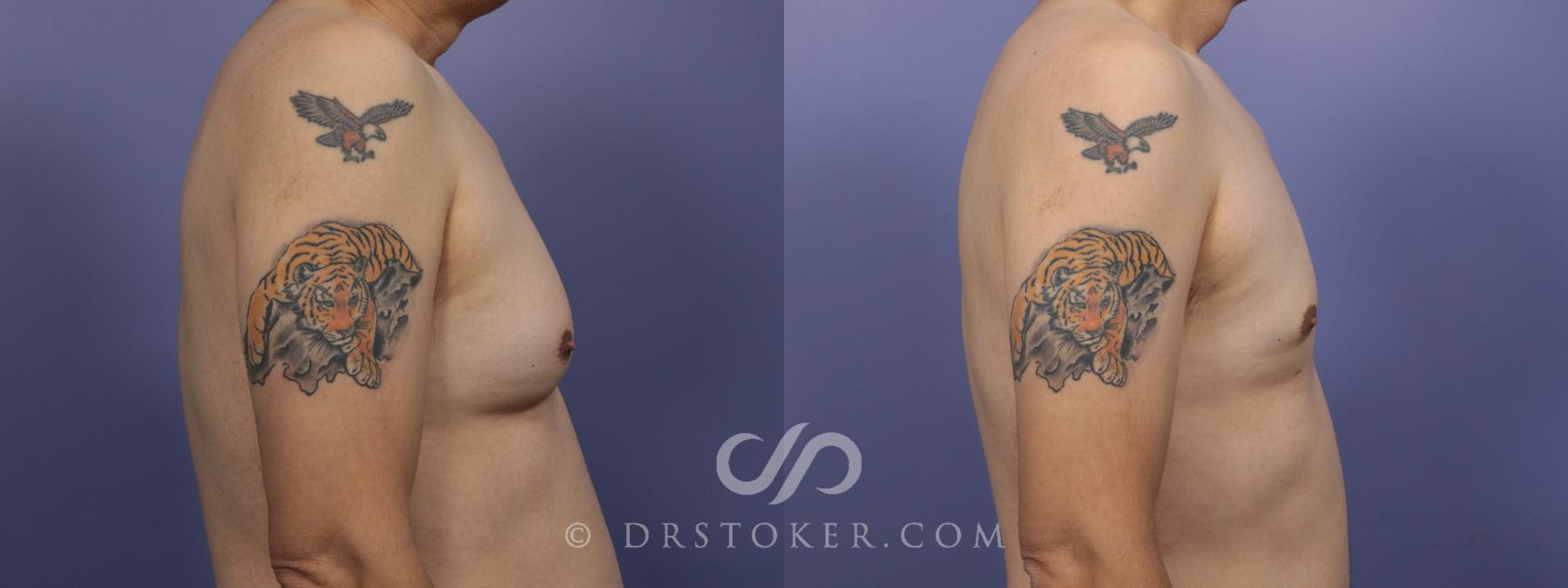 Before & After Breast Reduction for Men (Gynecomastia) Case 1412 View #3 View in Los Angeles, CA