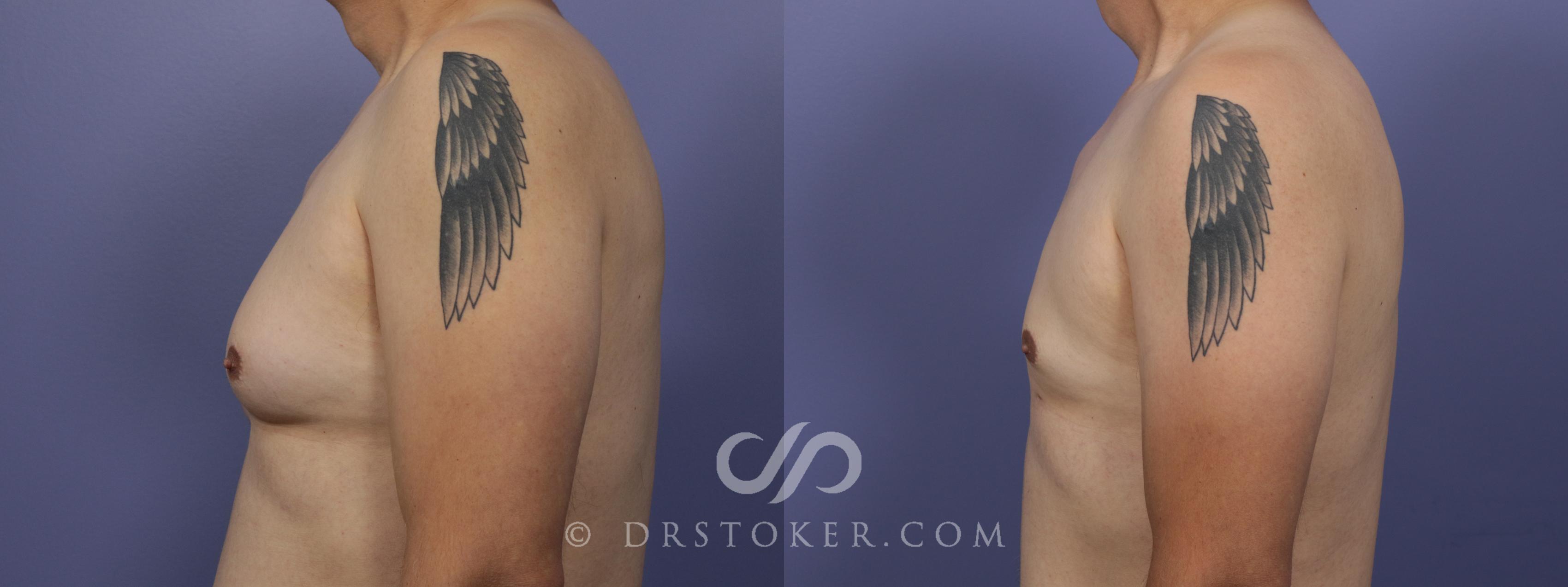 Before & After Breast Reduction for Men (Gynecomastia) Case 1412 View #4 View in Los Angeles, CA