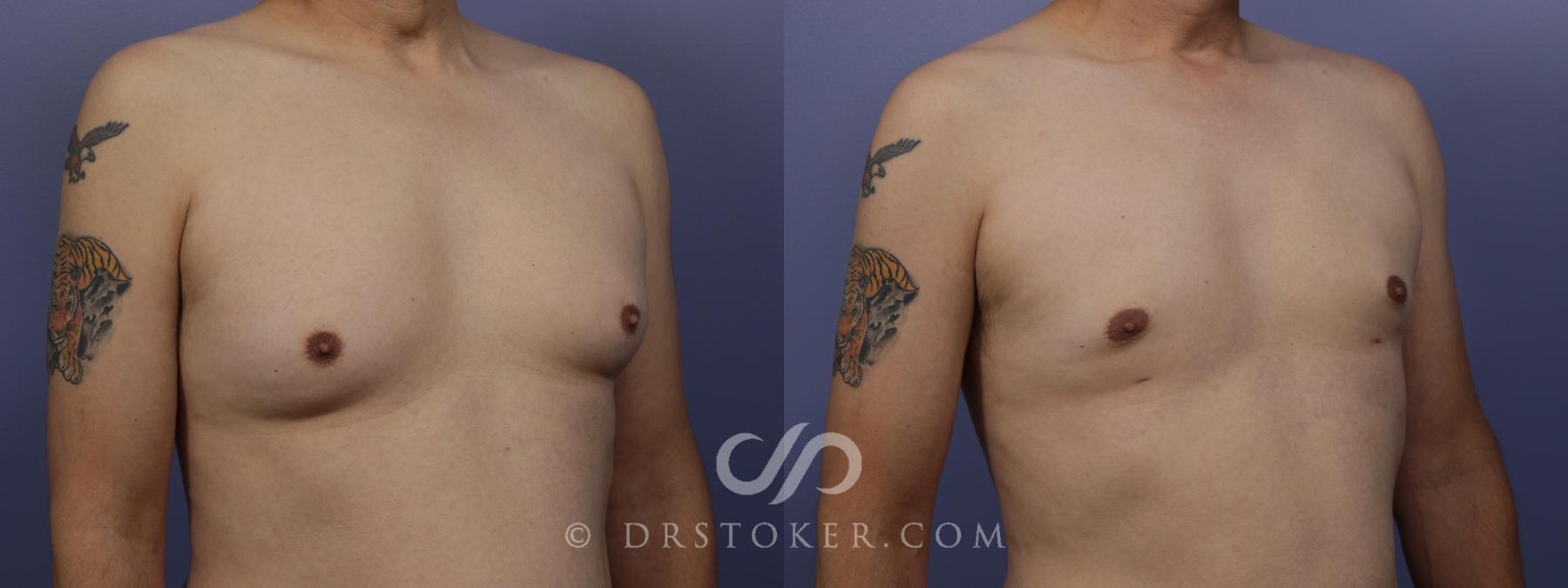 Before & After Breast Reduction for Men (Gynecomastia) Case 1412 View #5 View in Los Angeles, CA