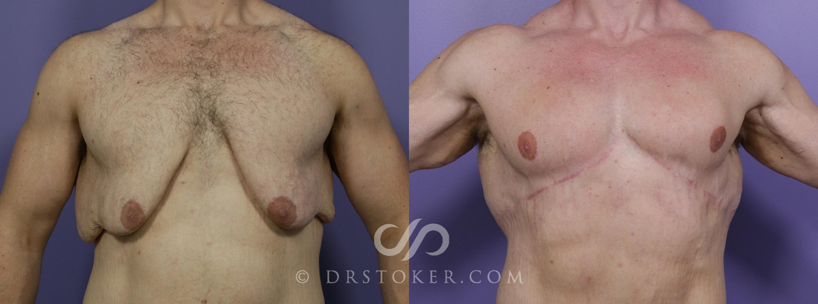 Before & After Breast Reduction for Men (Gynecomastia) Case 1717 View #1 View in Los Angeles, CA