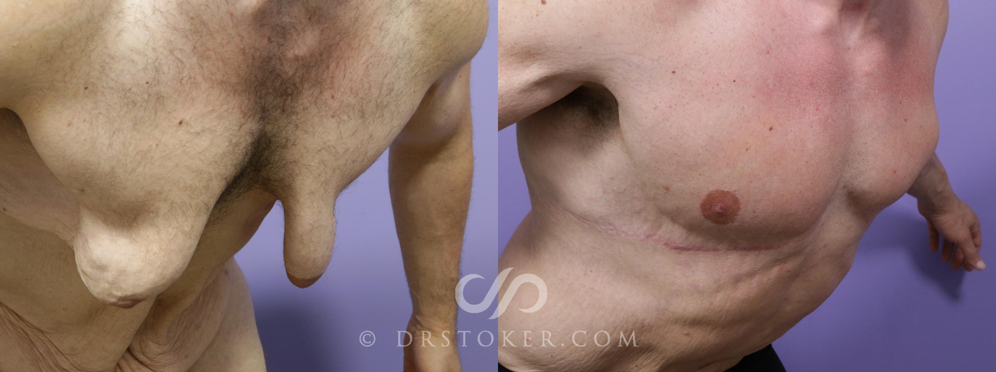 Before & After Tummy Tuck for Men Case 1720 View #1 View in Los Angeles, CA
