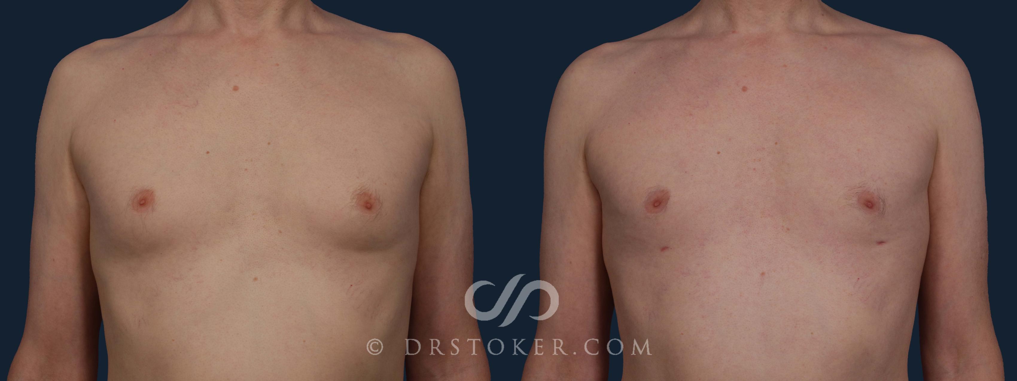 Before & After Breast Reduction for Men (Gynecomastia) Case 1957 Front View in Los Angeles, CA