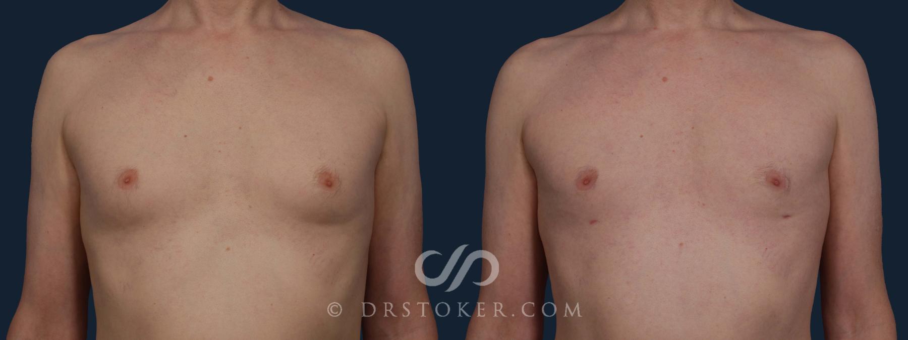 Before & After Breast Reduction for Men (Gynecomastia) Case 1959 Front View in Los Angeles, CA