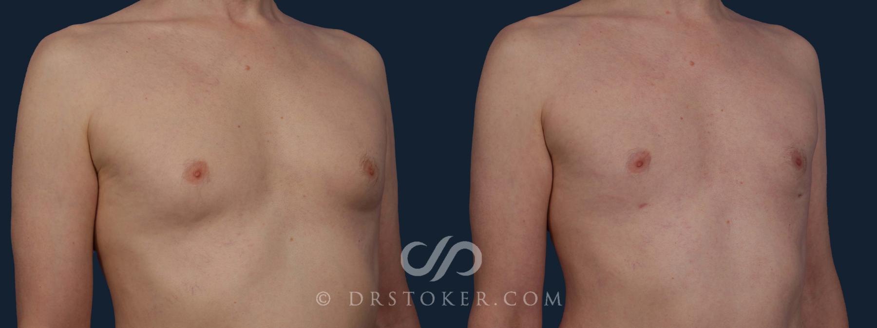 Before & After Breast Reduction for Men (Gynecomastia) Case 1960 Right Oblique View in Los Angeles, CA