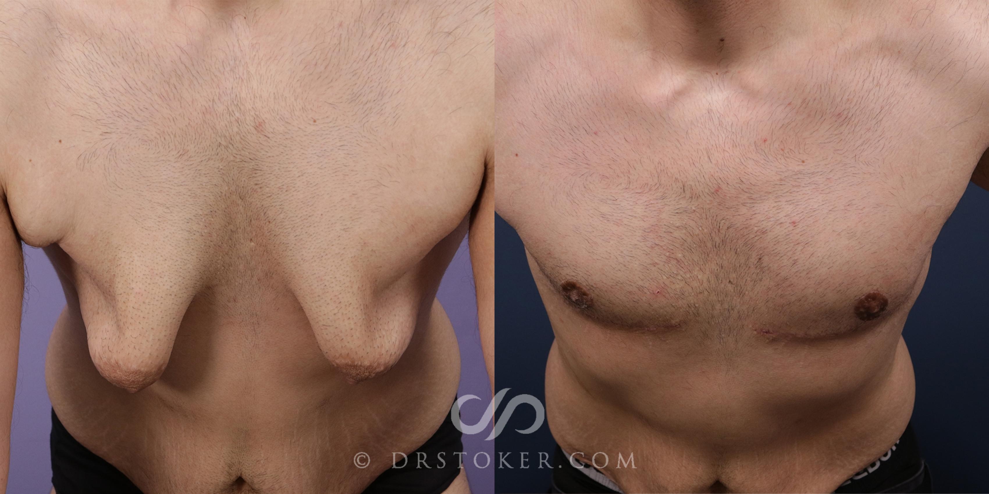 Before & After Breast Reduction for Men (Gynecomastia) Case 1991 Front View in Los Angeles, CA