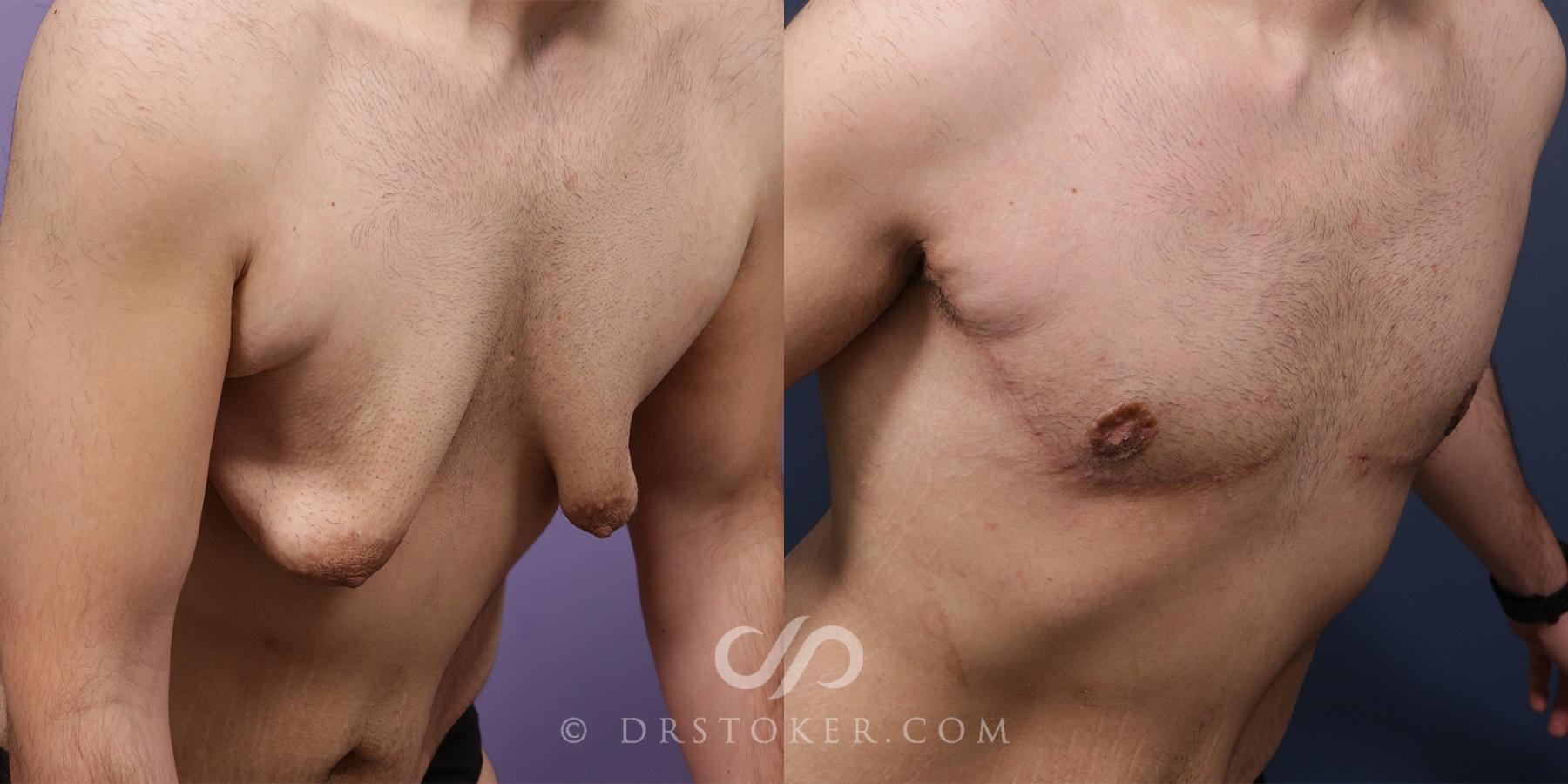 Before & After Breast Reduction for Men (Gynecomastia) Case 1992 Right Oblique View in Los Angeles, CA