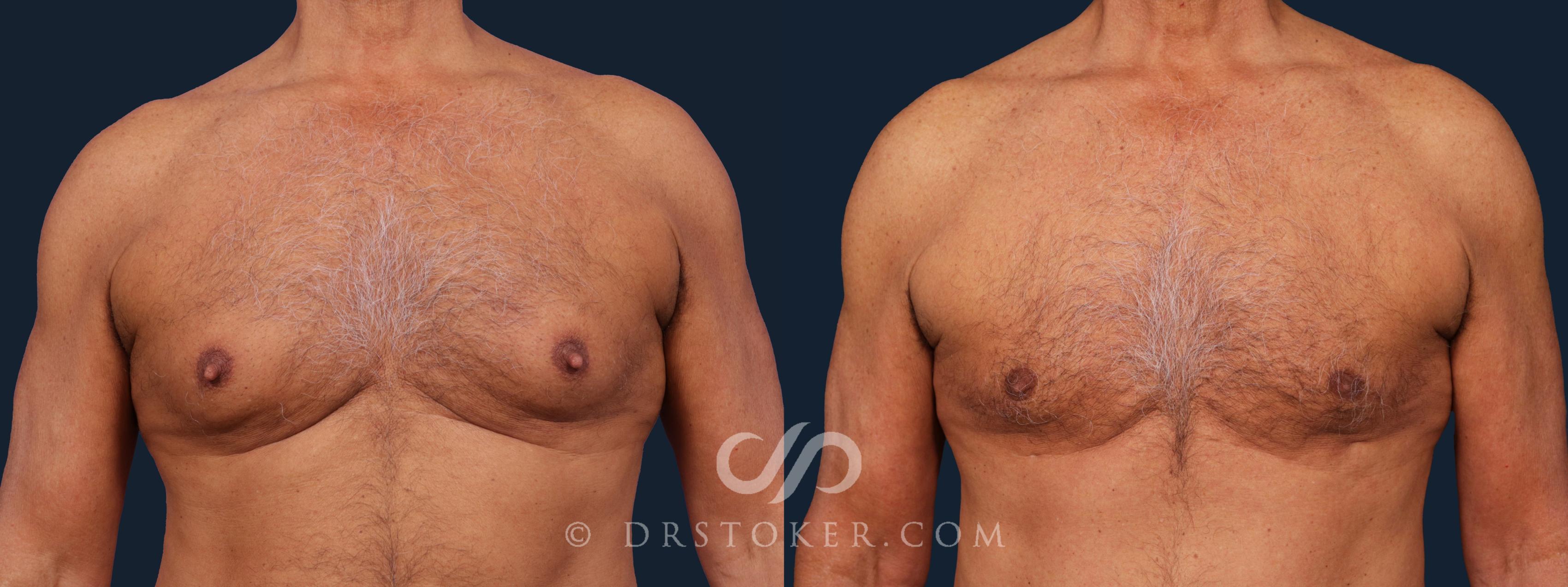 Before & After Breast Reduction for Men (Gynecomastia) Case 2023 Front View in Los Angeles, CA