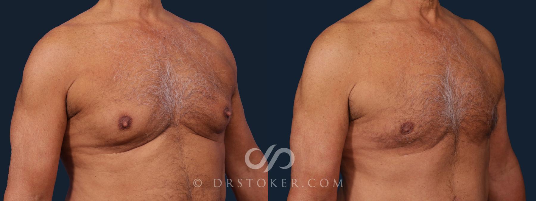 Before & After Breast Reduction for Men (Gynecomastia) Case 2023 Right Oblique View in Los Angeles, CA