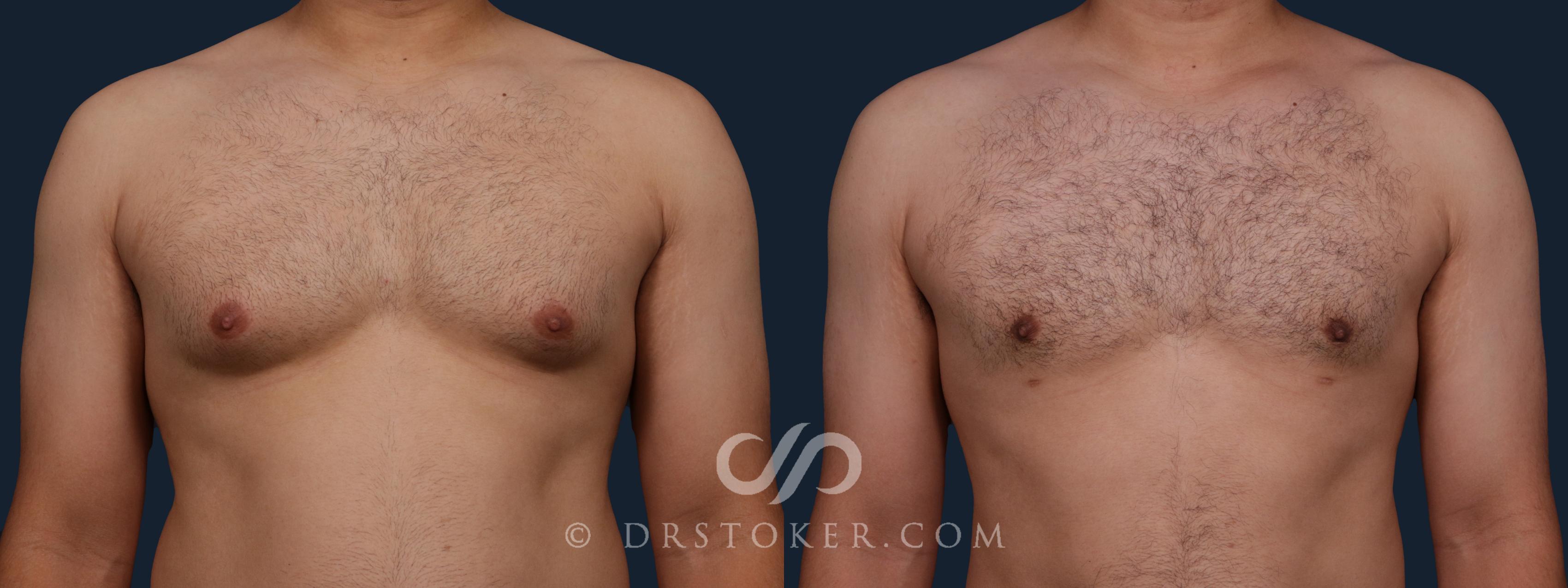 Before & After Breast Reduction for Men (Gynecomastia) Case 2177 Front View in Los Angeles, CA