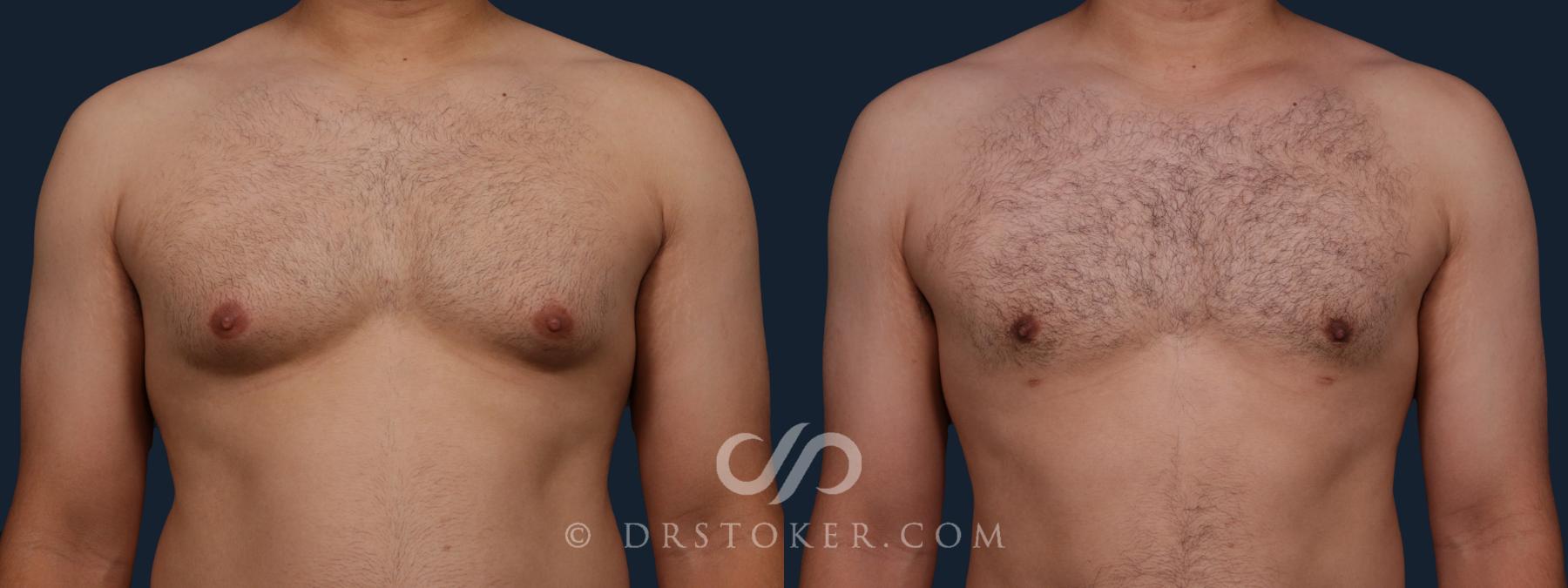 Before & After Breast Reduction for Men (Gynecomastia) Case 2177 Front View in Los Angeles, CA