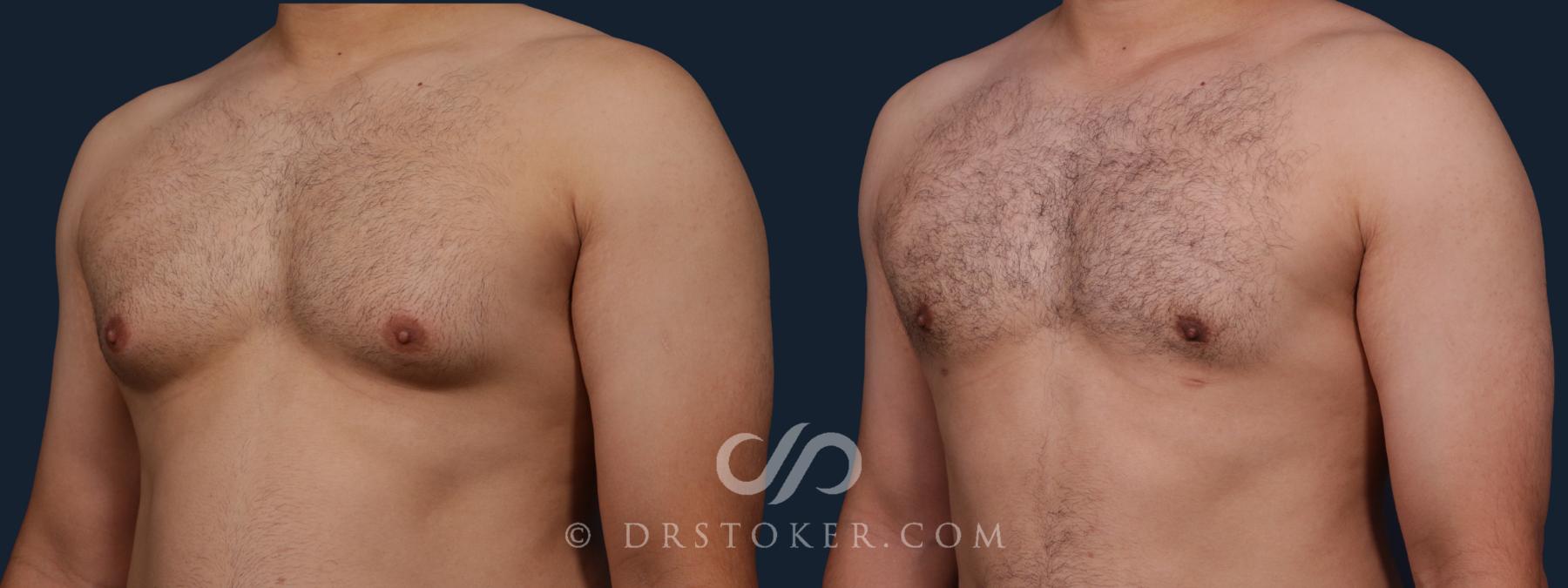 Before & After Breast Reduction for Men (Gynecomastia) Case 2177 Left Oblique View in Los Angeles, CA
