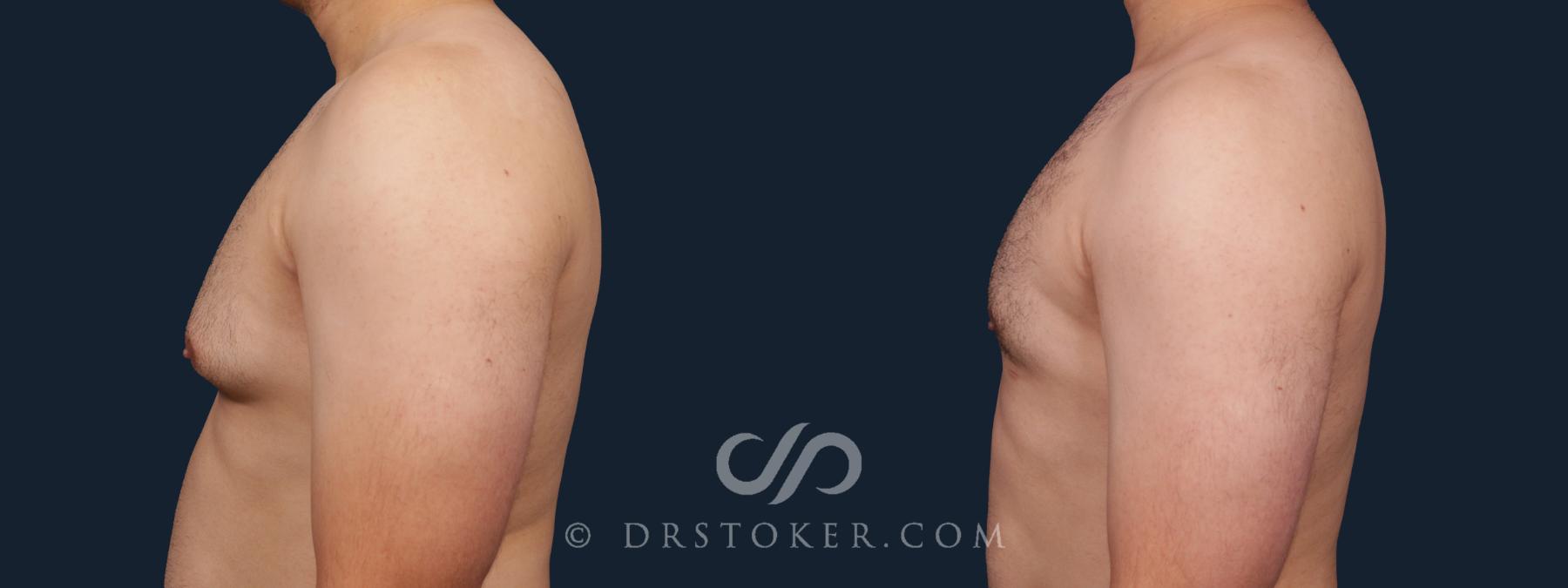 Before & After Breast Reduction for Men (Gynecomastia) Case 2177 Left Side View in Los Angeles, CA