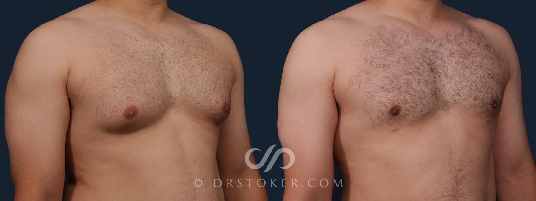 Before & After Breast Reduction for Men (Gynecomastia) Case 2177 Right Oblique View in Los Angeles, CA