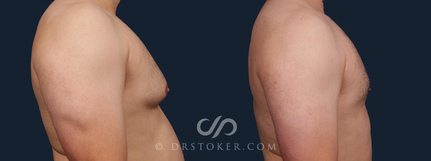 Before & After Breast Reduction for Men (Gynecomastia) Case 2177 Right Side View in Los Angeles, CA