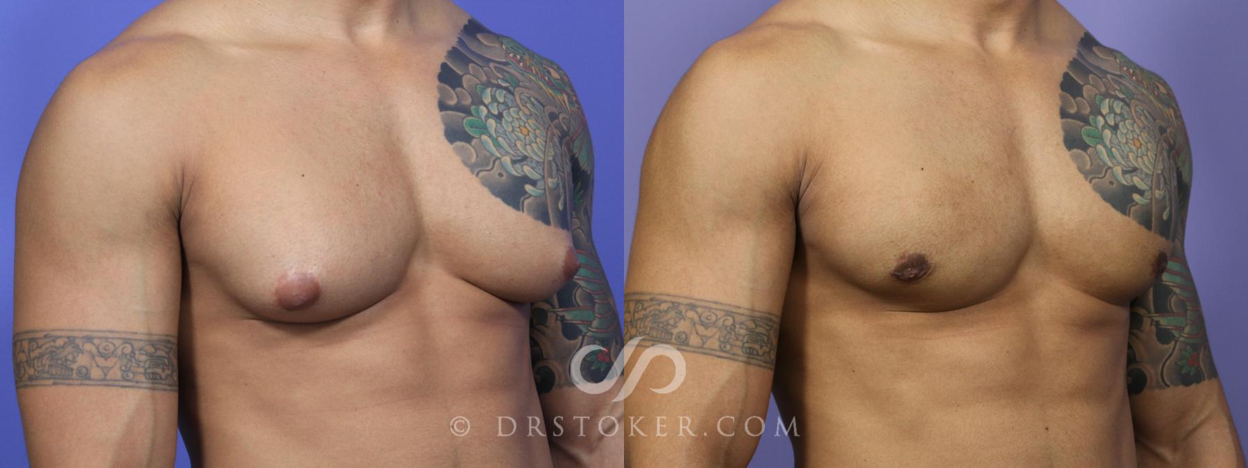 Before & After Breast Reduction for Men (Gynecomastia) Case 2230 Right Oblique View in Los Angeles, CA